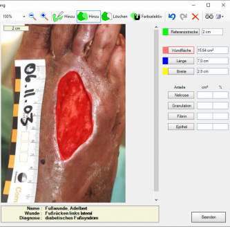 Wundvermessung
